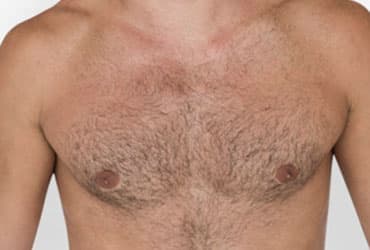 Body Hair Transplant Clinic in India 