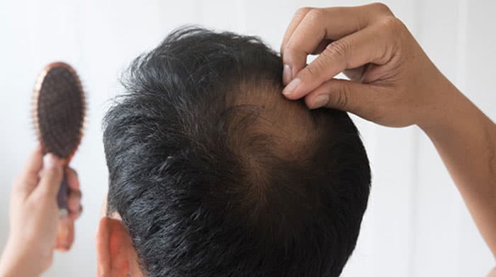 Hair loss treatment and Surgery 
